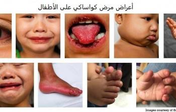 أعراض مرض كواساكي على الأطفال.jpg